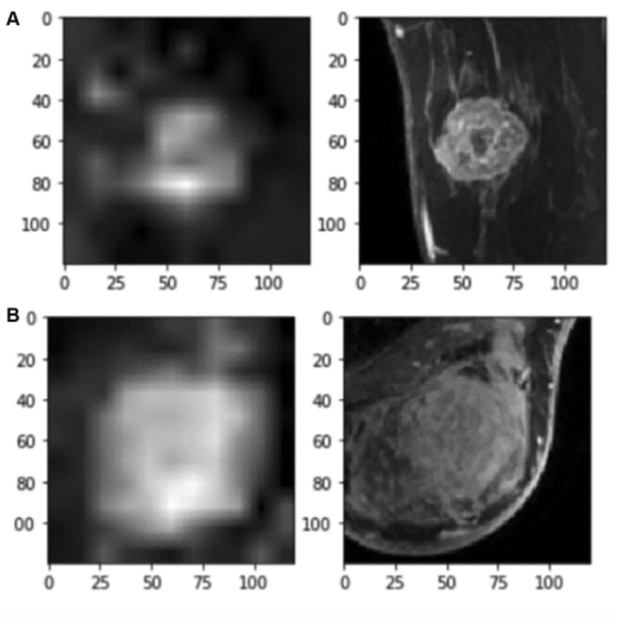 MRI-Based AI Model Shows Promise in Predicting Lymph Node Metastasis with Breast Cancer