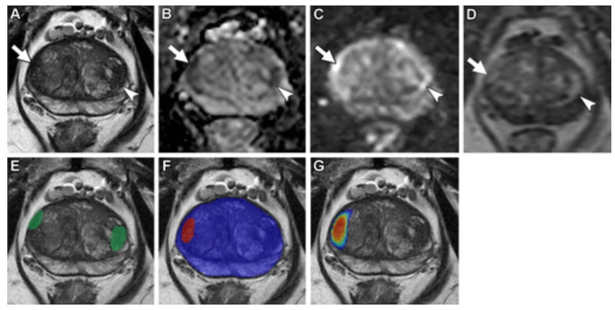 MRI-Based Deep Learning Algorithm Shows Comparable Detection of csPCa to Radiologists