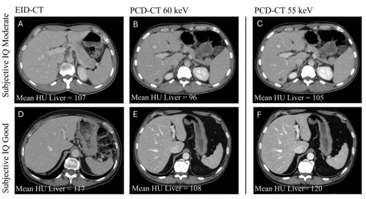 Abdominal CT Study Shows 20 Percent Reduction in Iodine Contrast with Photon Counting CT 