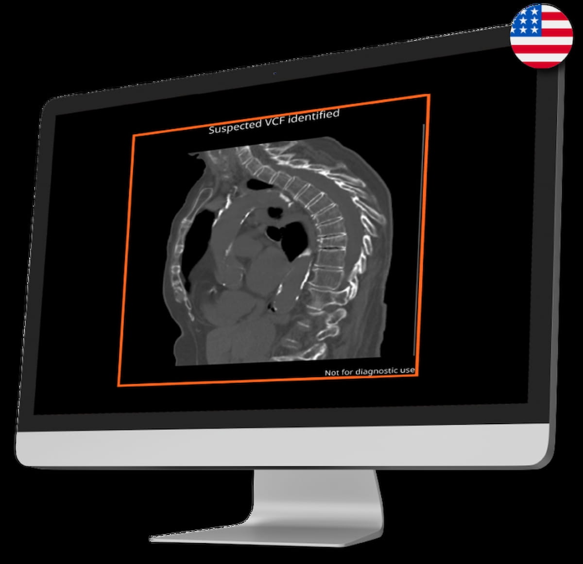 FDA Clears CT-Based AI Tool for Detecting Vertebral Compression Fractures