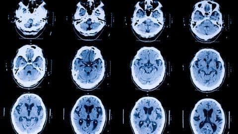 COVID-19 Neurological Impacts Similar to Those from Oxygen Deprivation