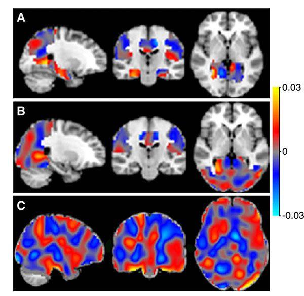 Arterial Spin Labeling Aids MRI in Alzheimer’s Classification 