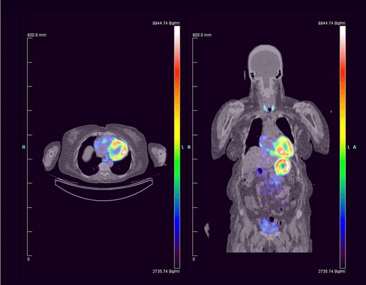 Emerging PET Imaging Agent Gets FDA’s Breakthrough Therapy Designation for Cardiac Amyloidosis