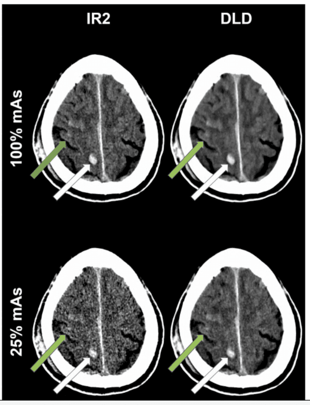 Study: Deep Learning Denoising May Facilitate Up to a 75 Percent Reduction in Radiation Dosing for Head CT