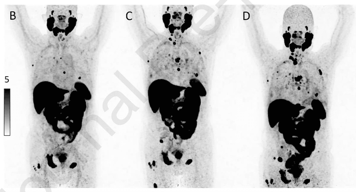 Study Shows Discordance Between PSMA PET/CT and PSA Response in 47 Percent of Patients Treated for mCRPC