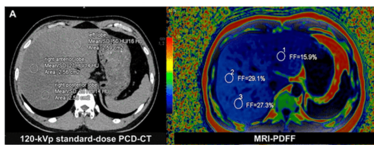 Can Photon-Counting CT Facilitate a Viable Alternative to MRI for Liver Fat Quantification in Patients with MASLD?