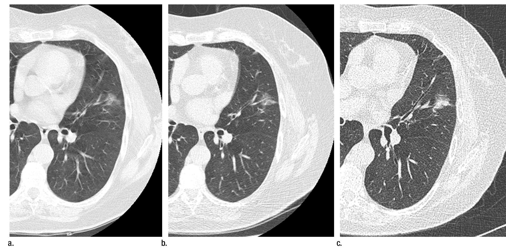 Observation of Nonsolid Lung Nodules By CT Is Safe