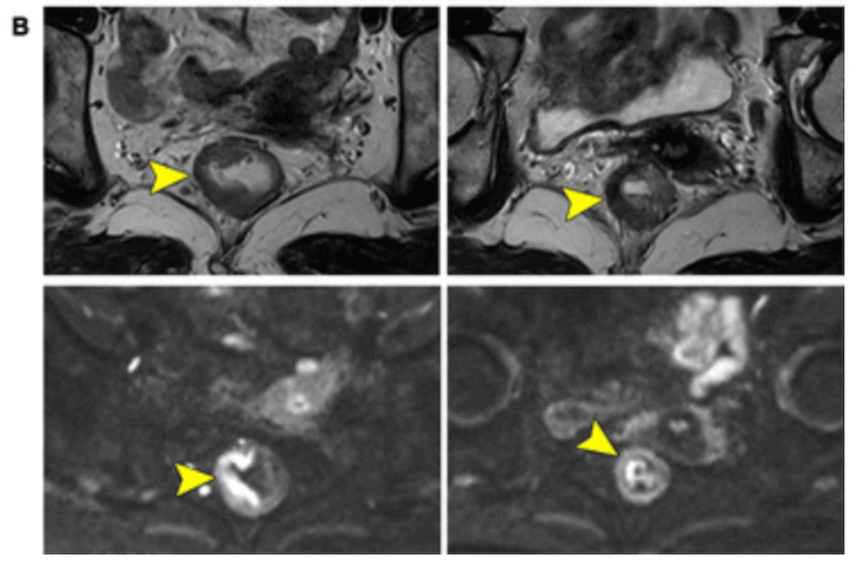 Diffusion-Weighted MRI and Neoadjuvant Chemotherapy for Rectal Cancer: What New Research Reveals