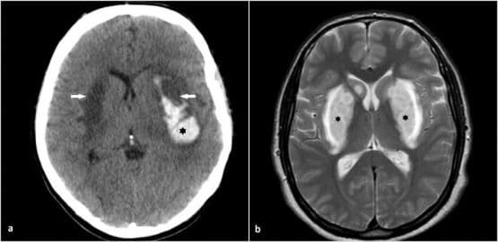 Brain Images Reveal Methanol Poisoning Associated with COVID-19 Pandemic