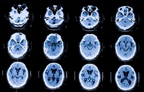 Repeat CTs in Normal Neurological Patients Following TBI Unnecessary 