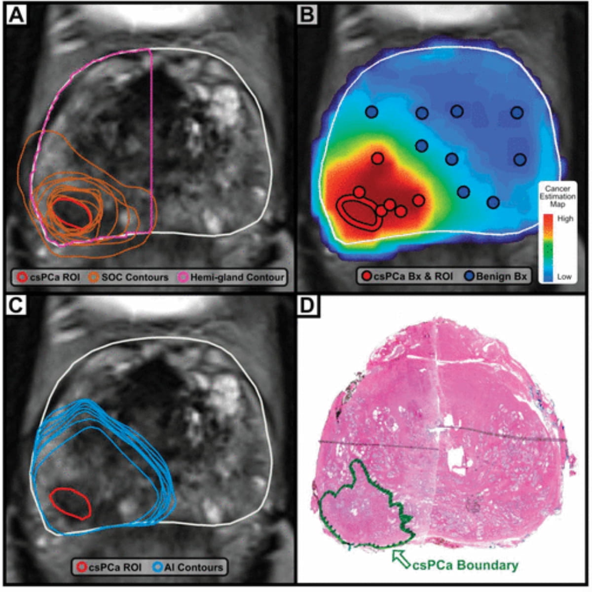 Study: Adjunctive AI Imaging Software Enhances Contouring of Prostate Cancer 