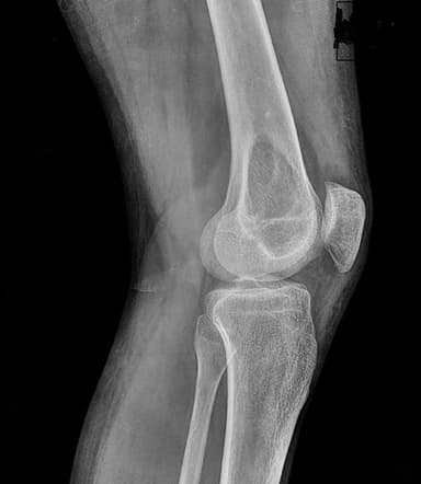 Image IQ: 24 y/o, History of Knee Pain Following Trauma