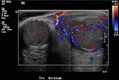 Image IQ: 10-year-old Male with Left Testicular Pain and Swelling