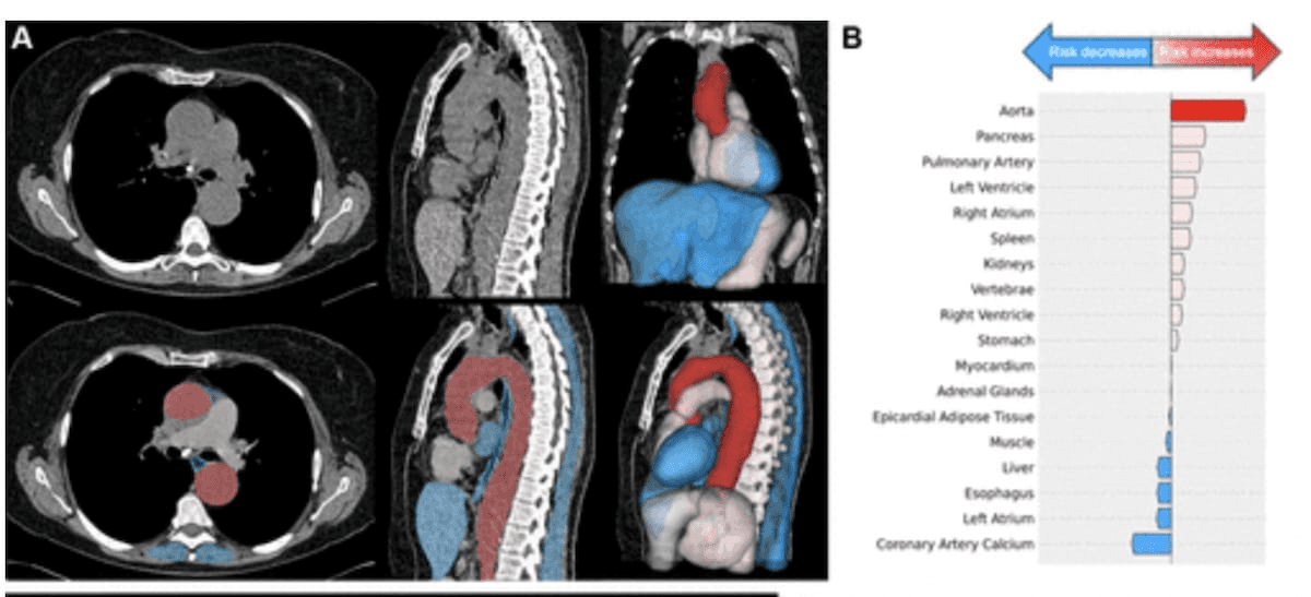 Can AI Enhance CT Detection of Incidental Extrapulmonary Abnormalities and Prediction of Mortality?