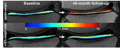 MRI Confirms, Weight Loss Good for Knees