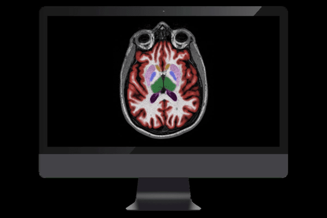 FDA Clears Updated AI Software for MRI Neuroimaging 