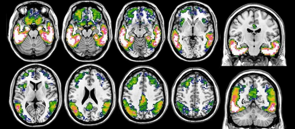 FDA Clears New Centiloid Scoring and Tau PET Quantification Tools