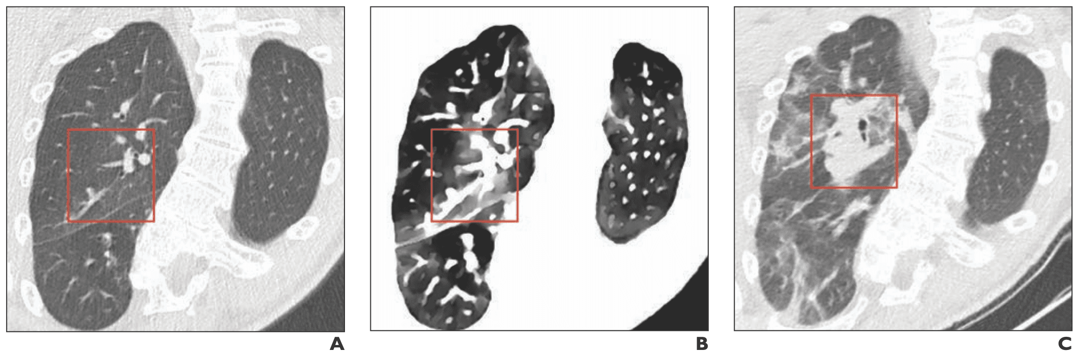 Spectral CT Makes Detecting Early-Stage COVID-19 Easier