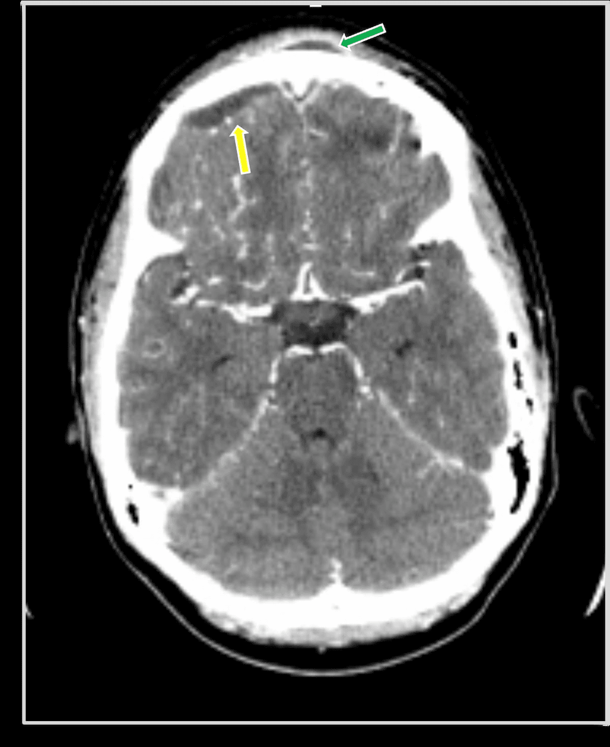 Image IQ Quiz: 38-Year-Old with Fever and Sinus Pain