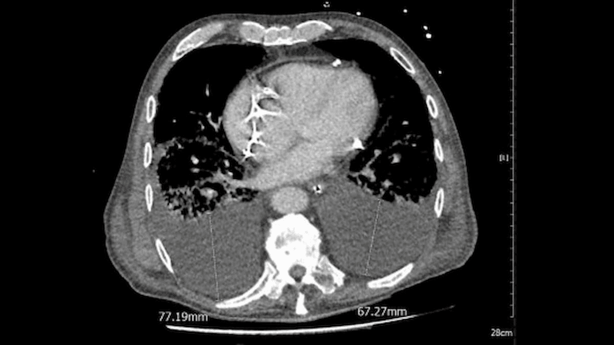 CT Study Links Pleural Effusion and Higher 30-Day Mortality Rates in Patients with COVID-19