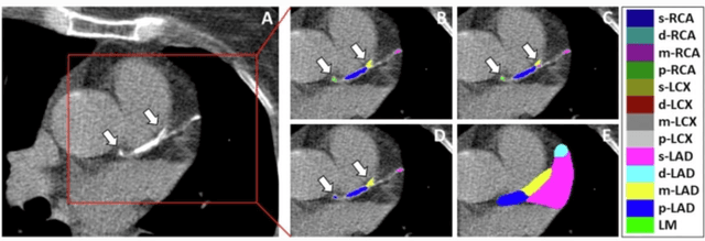 Computed Tomography Study Examines Potential of Automated Coronary Artery Calcium Scoring with Deep Learning