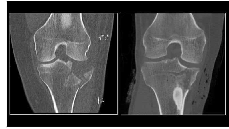 Ultra-low Dose CT Accurately Detects Pediatric Fractures