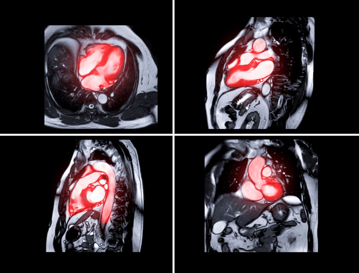 TeraRecon Launches Updated Intuition 4.10 Cardiac MRI Software