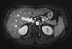 MRI Classifies Liver Cancer