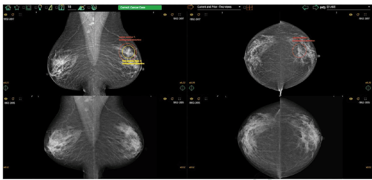 How Does Access to Previous Mammography Exams Impact Current Mammography Interpretation by Radiologists?