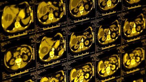 Focus on Smokers, Patients With Negative Lung CTs to Improve Lung Cancer Screening Adherence