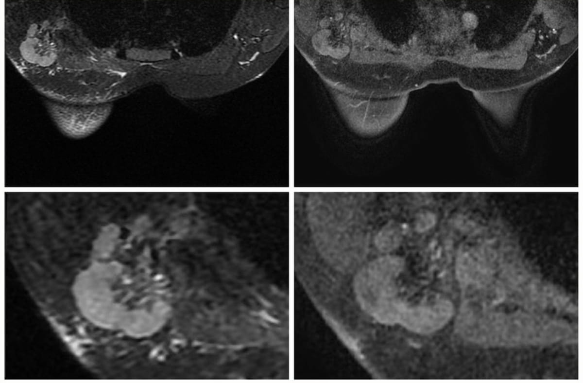 Breast MRI Study: Can Node-RADS Scoring Enhance Detection of Lymph Node Invasion in Breast Cancer?
