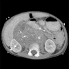 Readily Available MRI Technique Could Shed Light on Common Pediatric Cancer