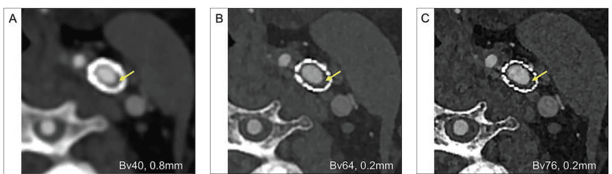 New Study Assesses Benefits of High-Resolution Photon-Counting for Computed Tomography Angiography 