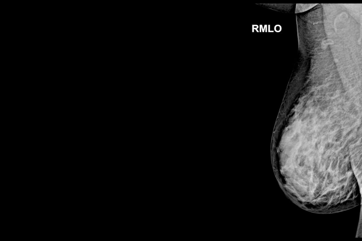 Findings from a recent survey of women in their 40s with no prior breast cancer history or BRCA1/2 gene mutation indicated that over a third of the respondents preferred to delay mammography screening. (Image courtesy of Adobe Stock.)