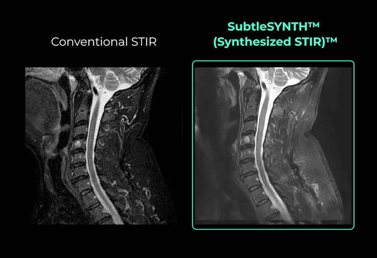 FDA Clears AI Software for Creating Synthetic MRI STIR Images