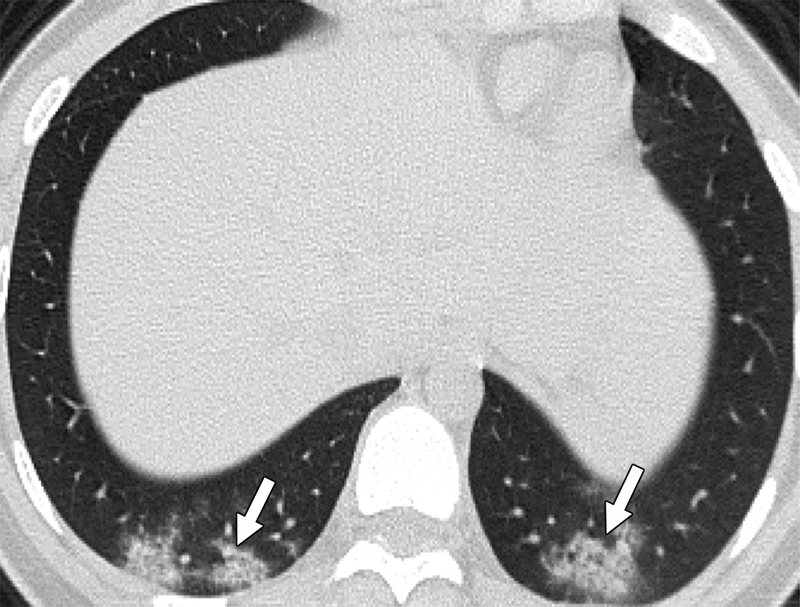 Most COVID-19-Positive Children Have Negative Chest CT Scans