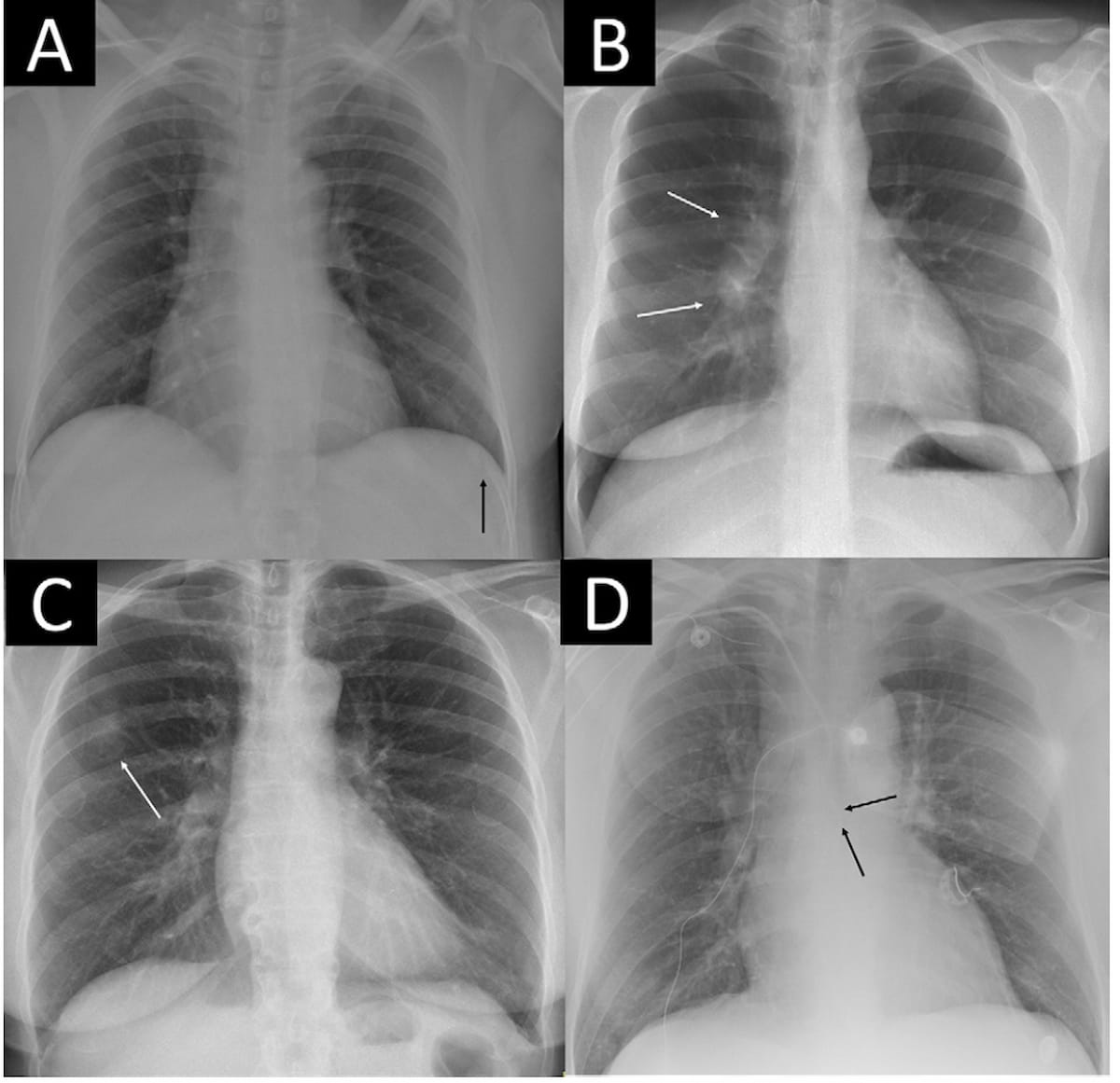 Could AI Help Mitigate Radiology Workloads for Unremarkable Chest X-Rays?