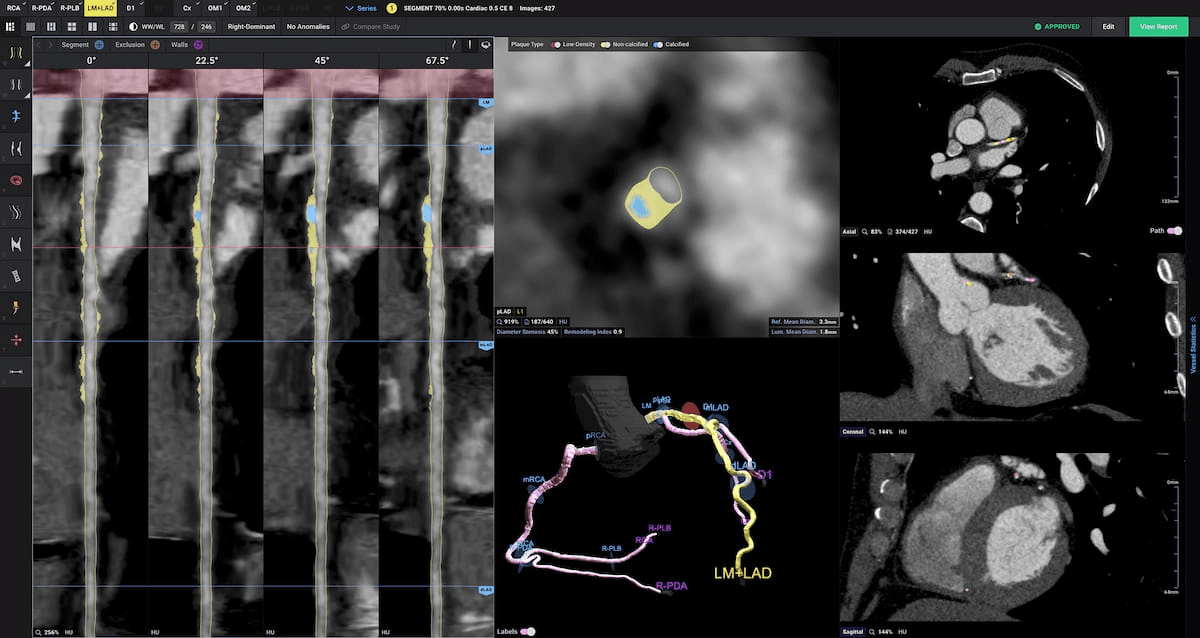 Multicenter Study Shows Capability of AI CCTA Analysis for Predicting Major Adverse Cardiovascular Events 