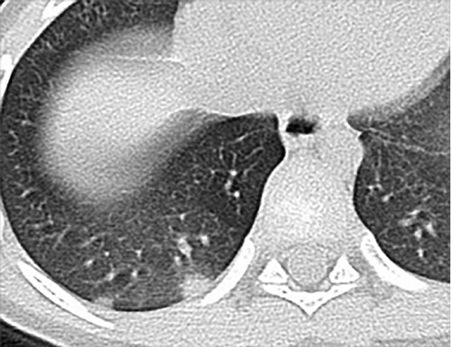 Children Experience Milder COVID-19 Cases