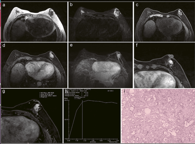 Enhancing Lesions on Breast MRI: Can an Updated Kaiser Scoring Model Improve Detection?