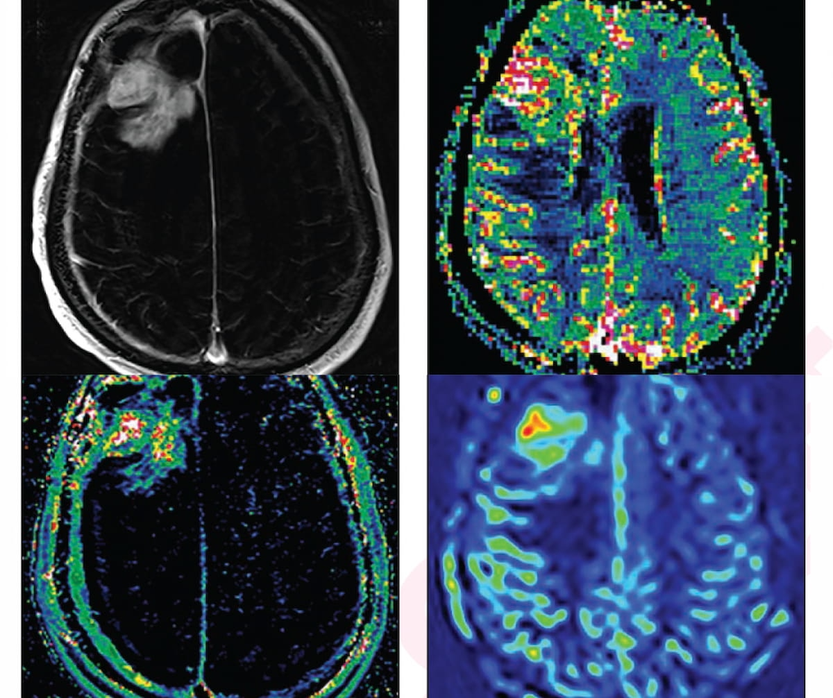 Study: Advanced MRI Neuroimaging May Have Changed Treatment for 44 Percent of Patients with High-Grade Gliomas