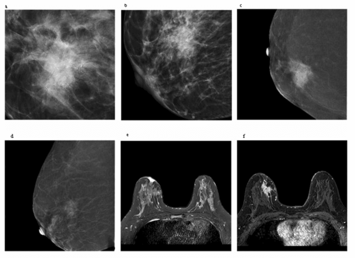 Is the Kaiser Score More Effective than BI-RADS for Assessing Contrast-Enhanced Mammography and MRI?