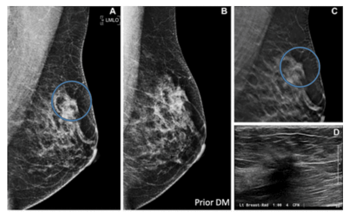 Comparing Digital Breast Tomosynthesis to Digital Mammography: What a Long-Term Study Reveals 