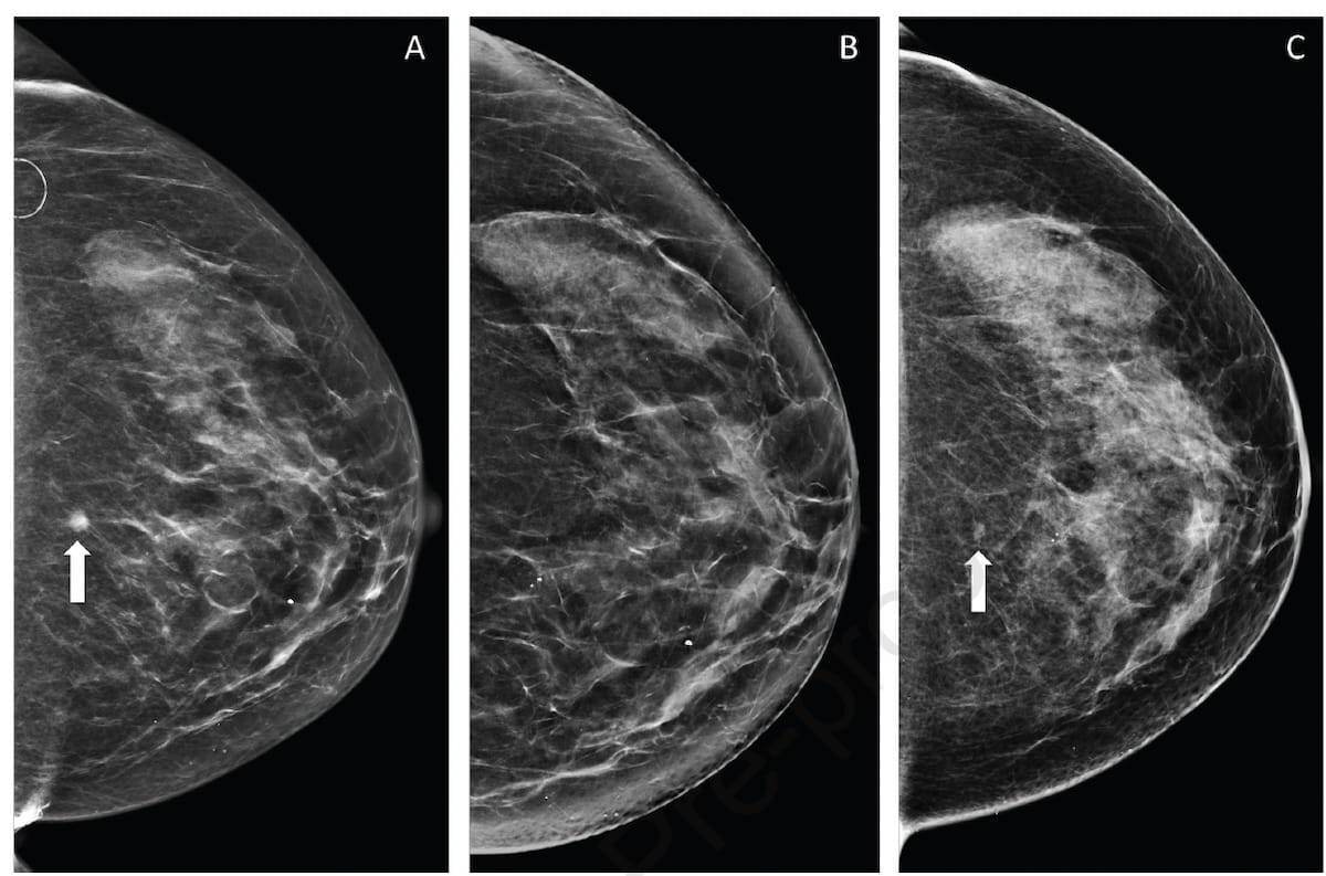 ACR Collaborative Model Leads to 35 Percent Improvement with Mammography Positioning Criteria