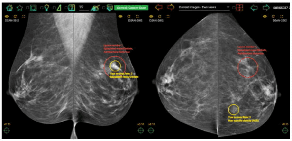 Radiology Experience, Breast Density and Screening Mammography: What New Research Reveals