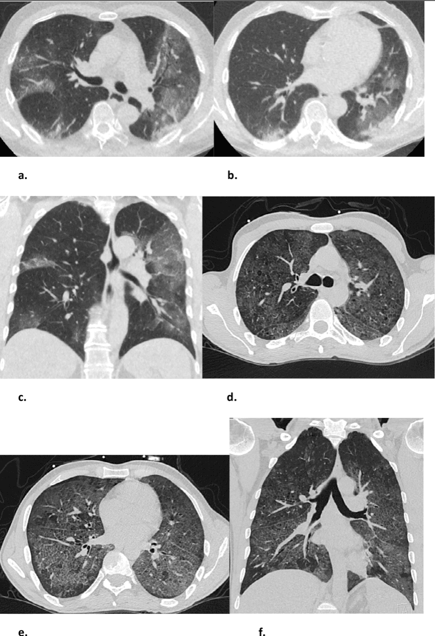 Pairing Chest CT and CO-RADS Gives “Rapid Test Result” for Some COVID-19 Patients