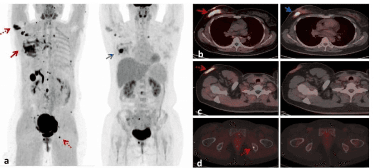 Researchers Show Higher Breast Cancer Upstaging Rate with 18F-FAPI PET/CT