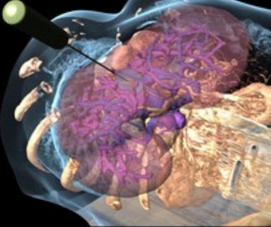 Techsomed Launches Ultrasound-Based Software Suite for Liver Tumor Ablation Therapy