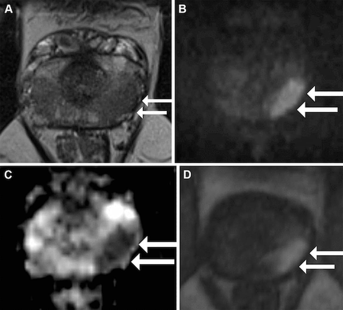 Study: mpMRI-Targeted Biopsies Offer Better Detection of Cribriform and Intraductal PCa than Systematic Biopsies