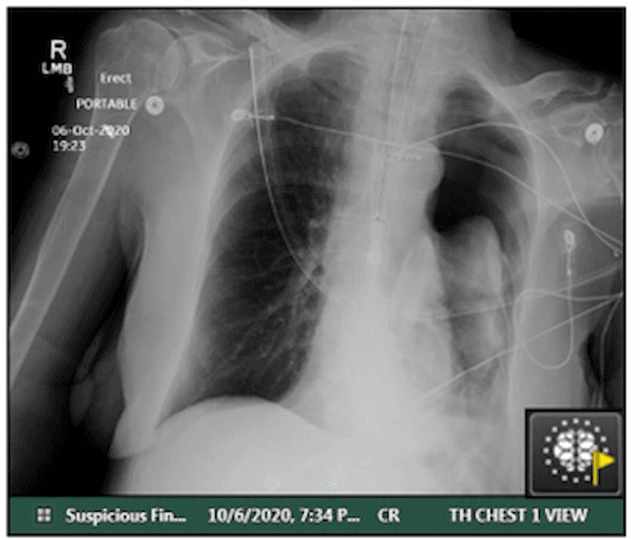 AI Bolsters Sensitivity for Pneumothorax on CXR and Significantly Reduces Reporting Time